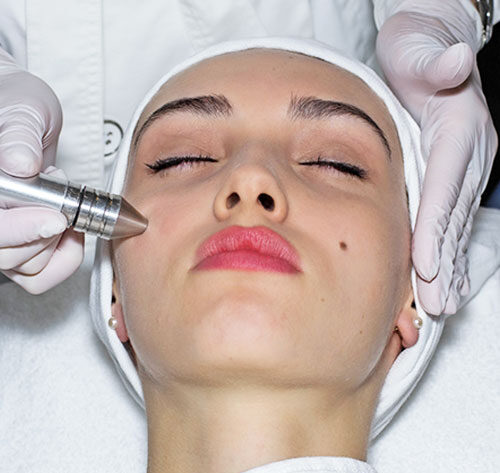 dermabrasion